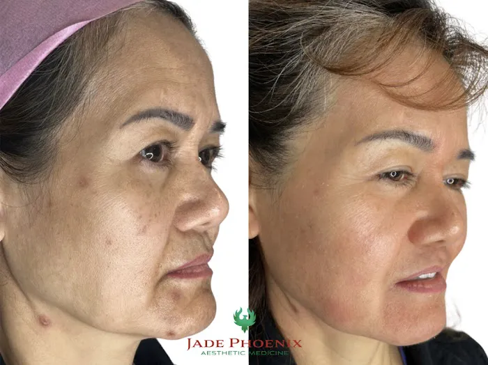 Jade Phoenix Aesthetic Medicine Med Spa - #1 Morpheus8, Microneedling, Hair Transplant, Fillers, & P Shot Picture 8