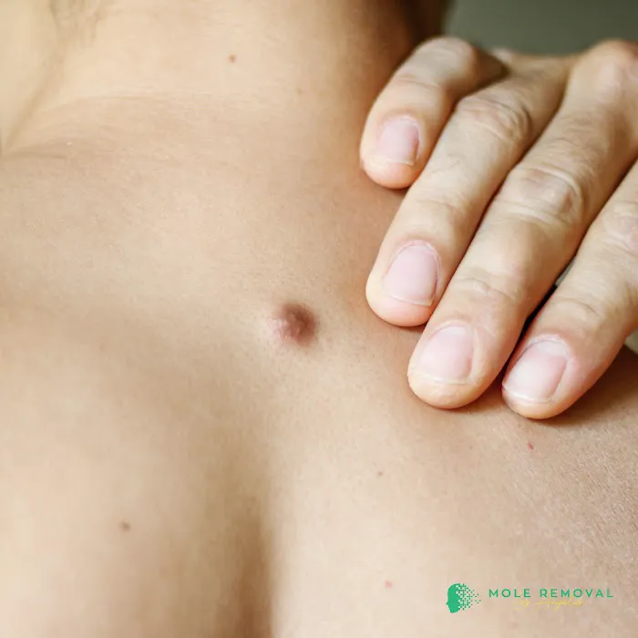 Mole Removal Los Angeles Picture 4