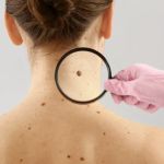 Mole Removal Los Angeles