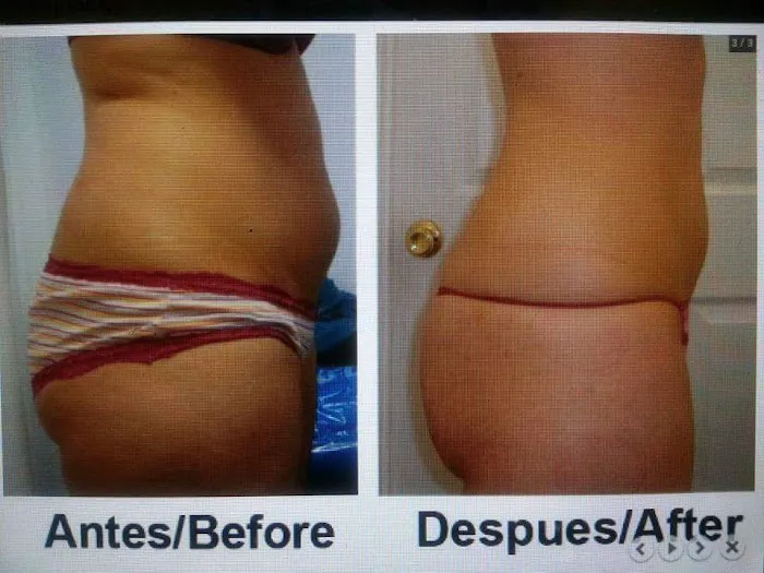 Body Sculpting Picture 6