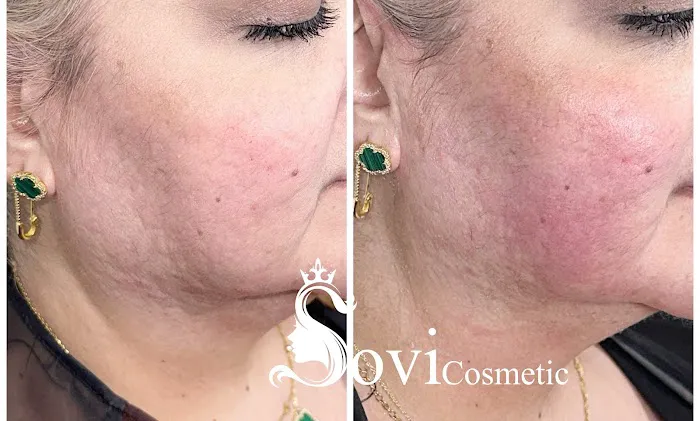 SOVI Cosmetic Picture 1