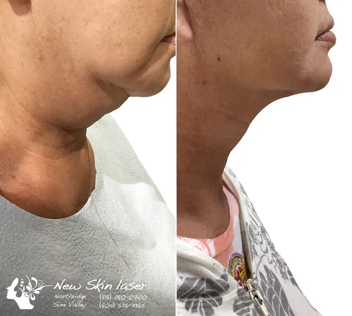 NewSkin Laser Center Picture 7