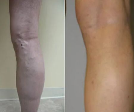 VSA - Vein Specialists of California