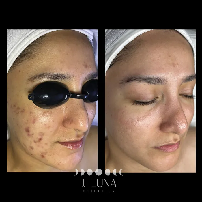 J. Luna Acne Clinic + Esthetics Picture 8