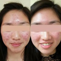 Proderma Acne Treatment System for Teens ico