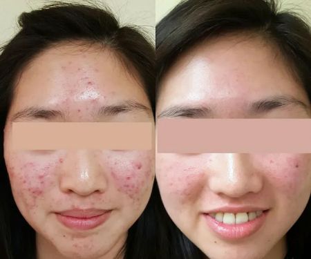 Proderma Acne Treatment System for Teens