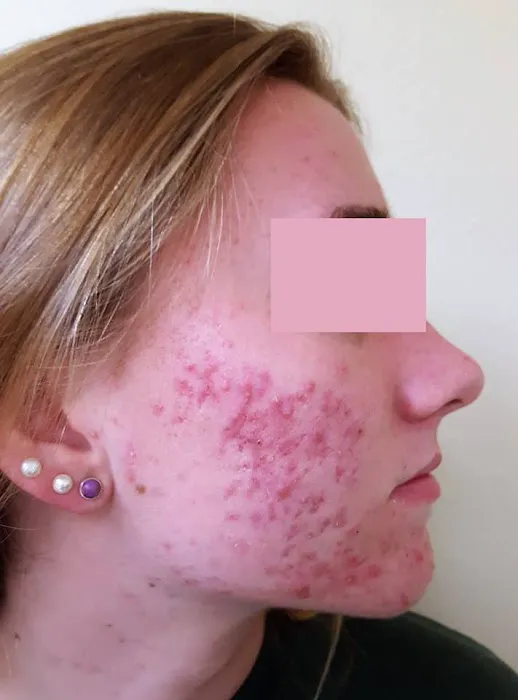 Proderma Acne Treatment System for Teens Picture 4