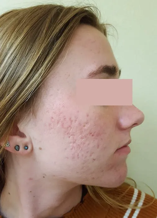 Proderma Acne Treatment System for Teens Picture 2