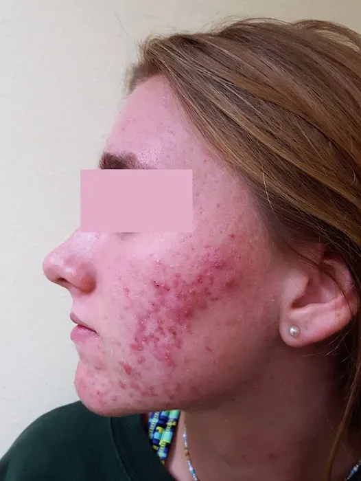 Proderma Acne Treatment System for Teens Picture 5