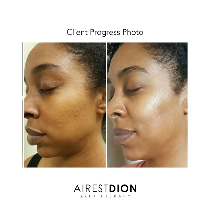 AirestDion Skin Therapy Picture 2