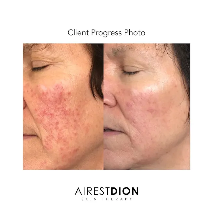 AirestDion Skin Therapy Picture 1
