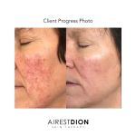 AirestDion Skin Therapy