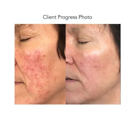 AirestDion Skin Therapy