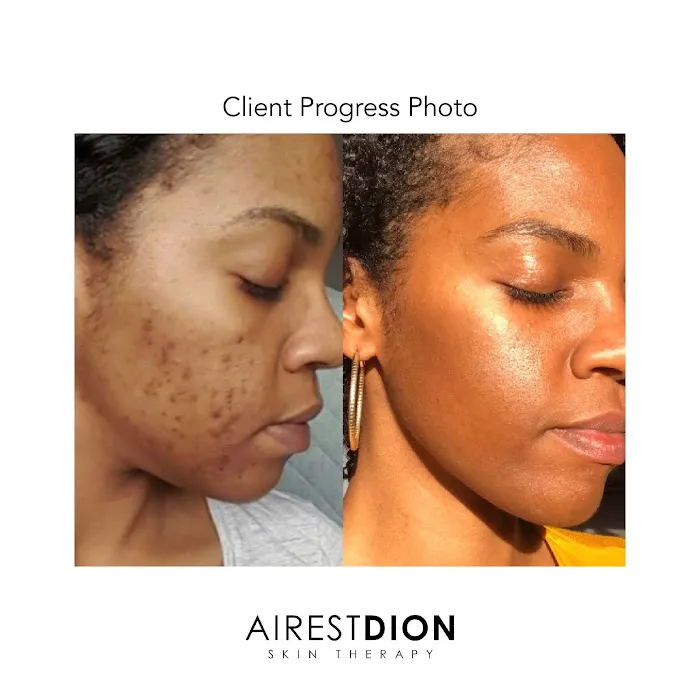 AirestDion Skin Therapy Picture 6