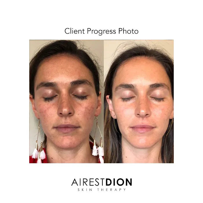 AirestDion Skin Therapy Picture 5