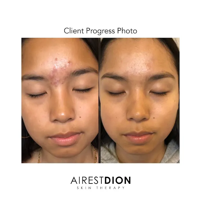 AirestDion Skin Therapy Picture 3