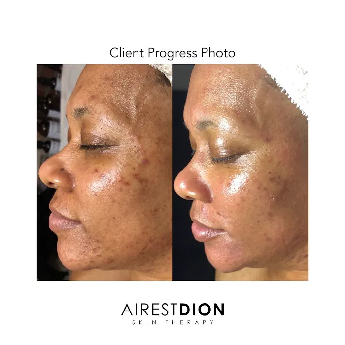 AirestDion Skin Therapy Picture 4