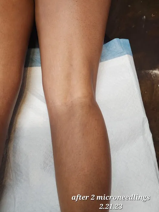 Microneedling Queen Picture 1