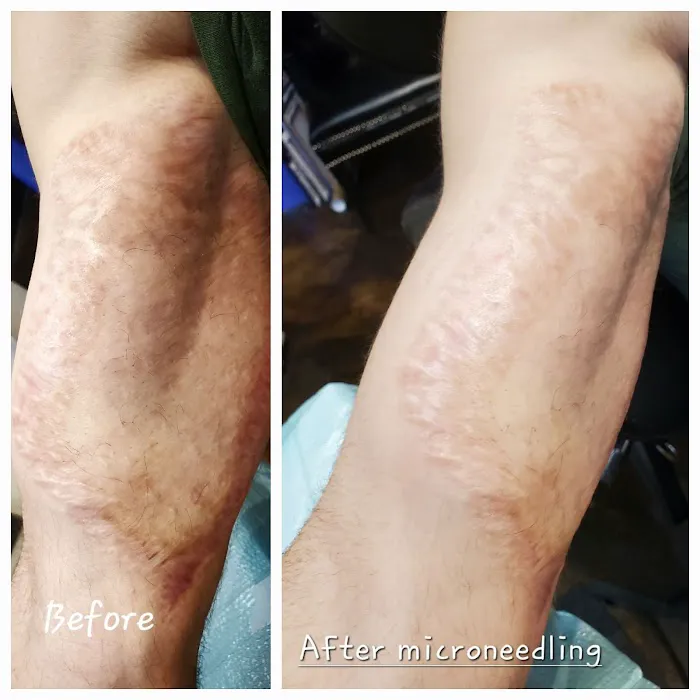 Microneedling Queen Picture 3