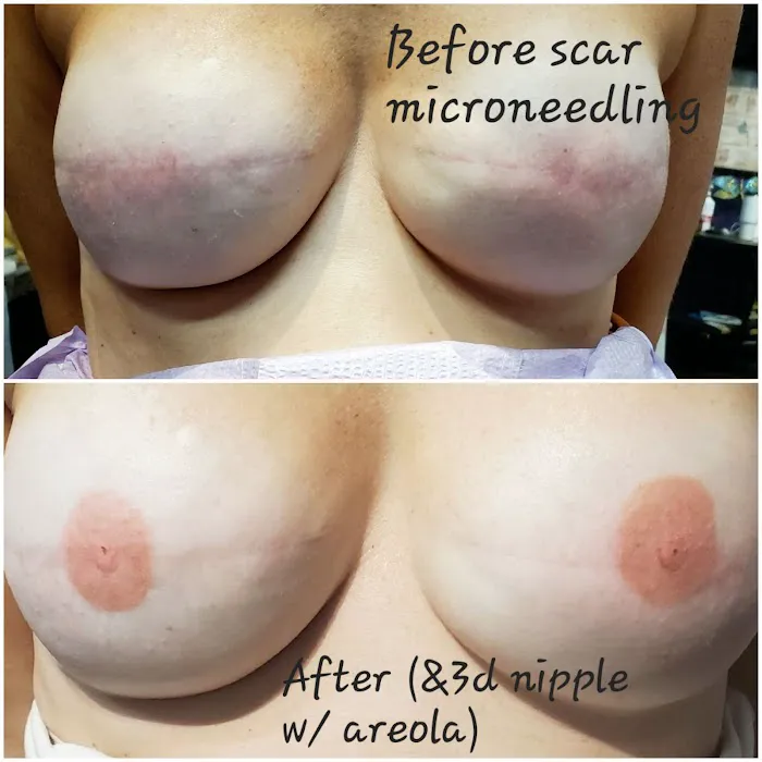 Microneedling Queen Picture 8