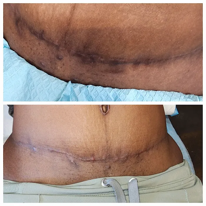 Microneedling Queen Picture 5