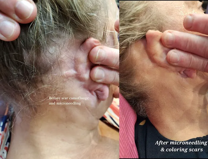 Microneedling Queen Picture 7