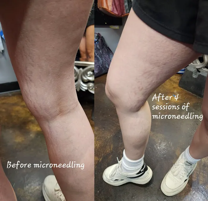 Microneedling Queen Picture 9