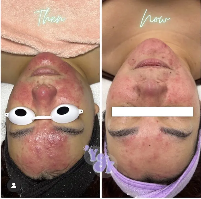 L.R. Acne Lab Picture 4