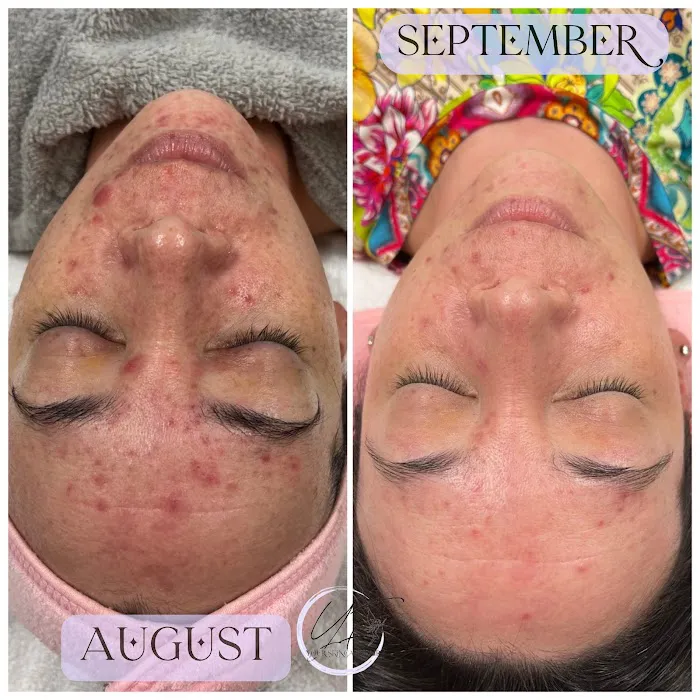 L.R. Acne Lab Picture 5