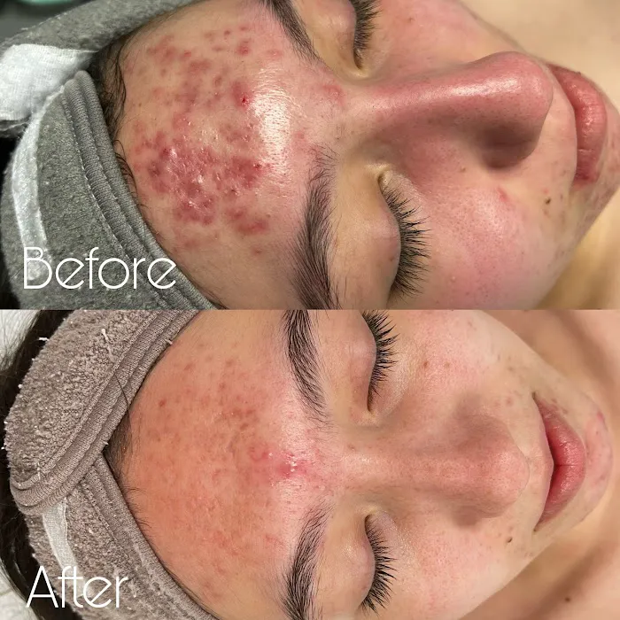 L.R. Acne Lab Picture 6