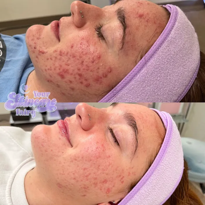 L.R. Acne Lab Picture 10