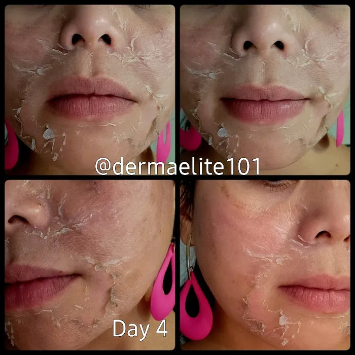 Derma Elite 101 Picture 10