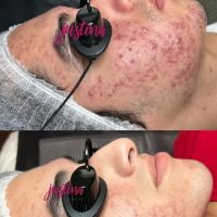 Acne Clinic Las Vegas by Justina ico