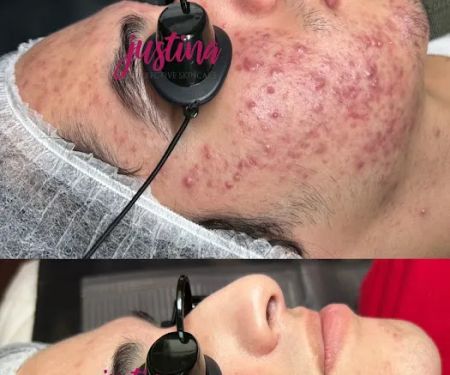 Acne Clinic Las Vegas by Justina