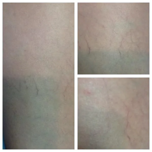 Las Vegas Laser Skin Care Picture 1