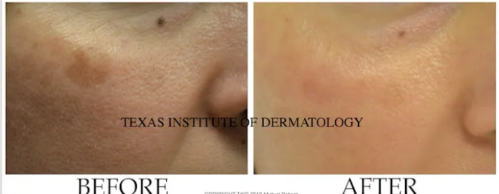 Texas Institute of Dermatology, Laser and Cosmetic Surgery Picture 8