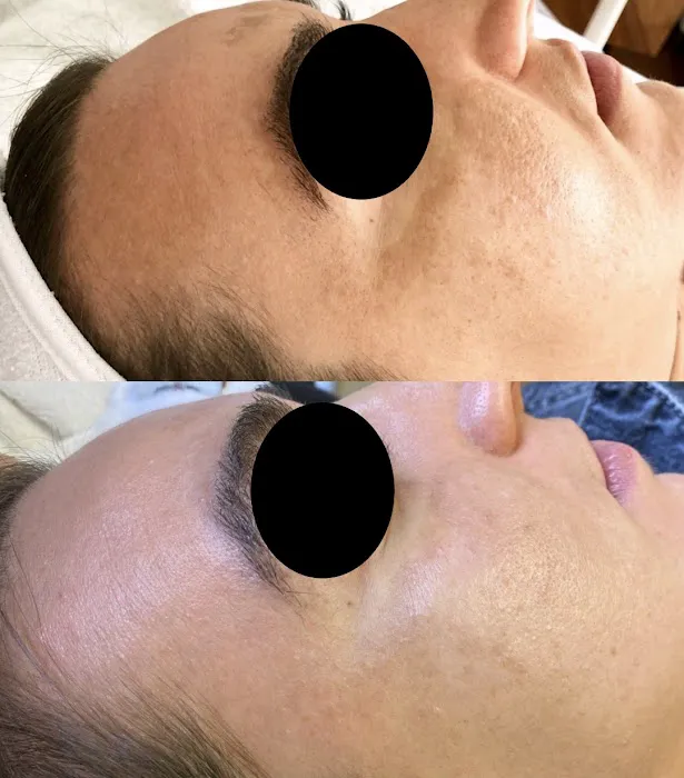 The Peel Connection - Chemical peels Picture 2