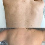 The Peel Connection - Chemical peels