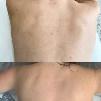 The Peel Connection - Chemical peels ico