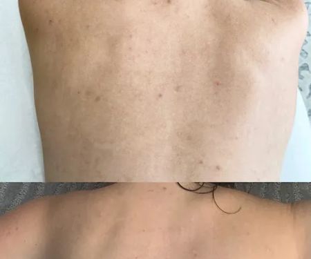 The Peel Connection - Chemical peels