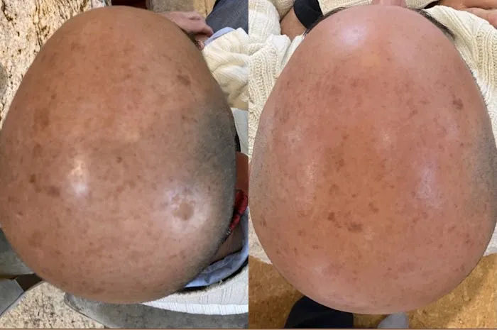 The Peel Connection - Chemical peels Picture 3