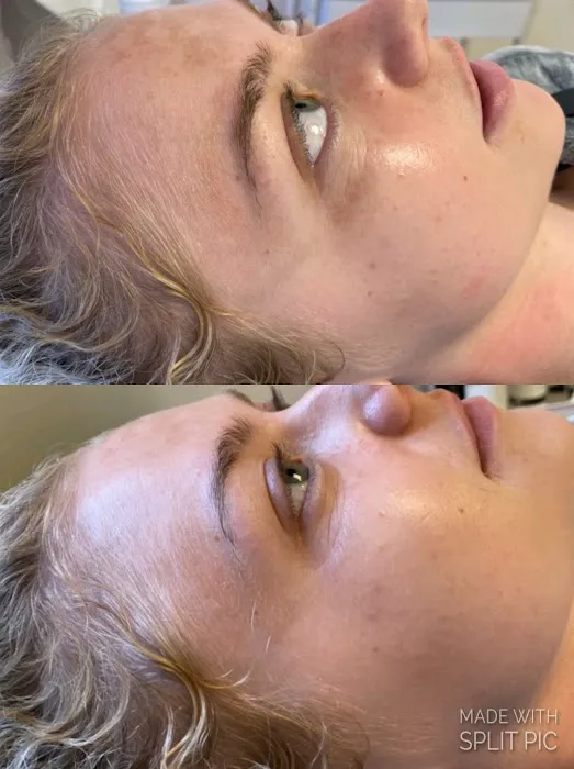 The Peel Connection - Chemical peels Picture 10