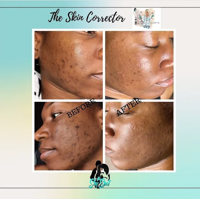 Shy Spot Skin Corrector Picture 3