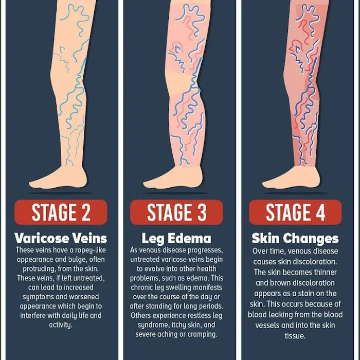 Varicose Vein Treatment Clinic Arlington Heights Picture 4