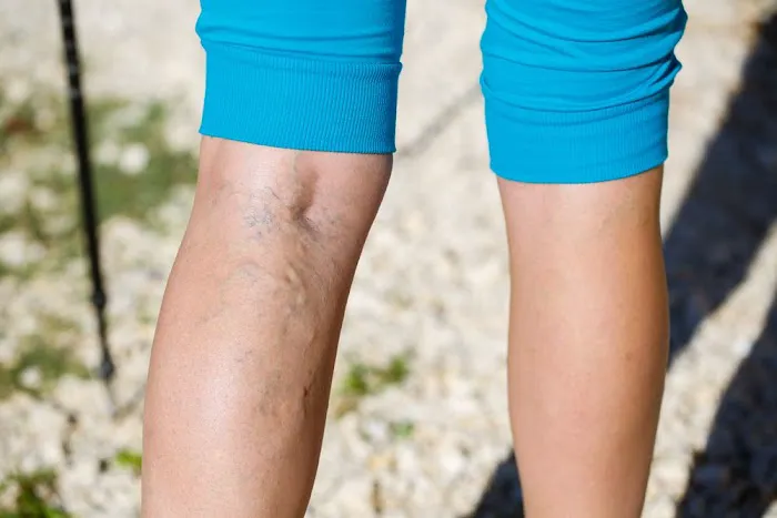 Varicose Vein Treatment Clinic Arlington Heights Picture 1