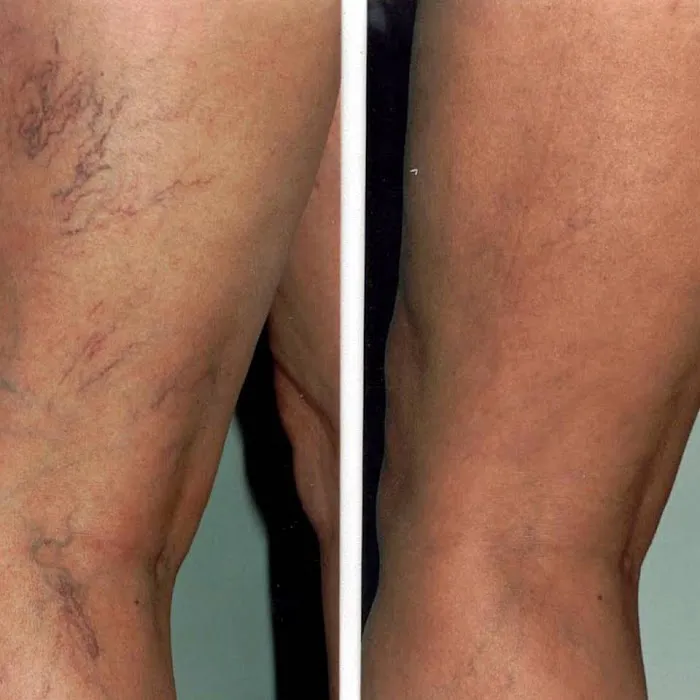 Varicose Vein Treatment Clinic Arlington Heights Picture 5