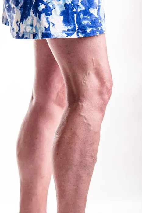 Varicose Vein Treatment Clinic Arlington Heights Picture 3