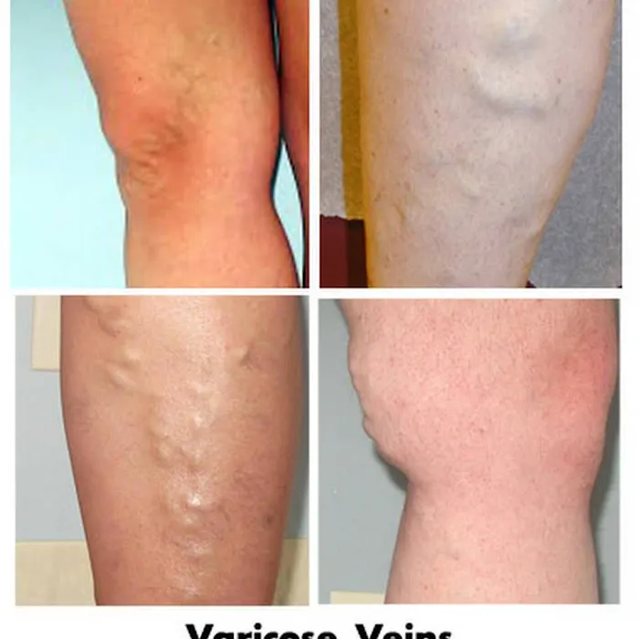 Varicose Vein Treatment Clinic Arlington Heights Picture 7