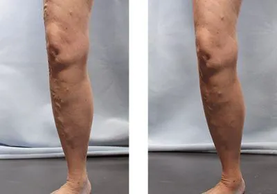 Palatine Varicose Vein Treatment Clinic Picture 4