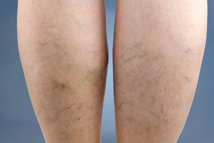 Palatine Varicose Vein Treatment Clinic Picture 1